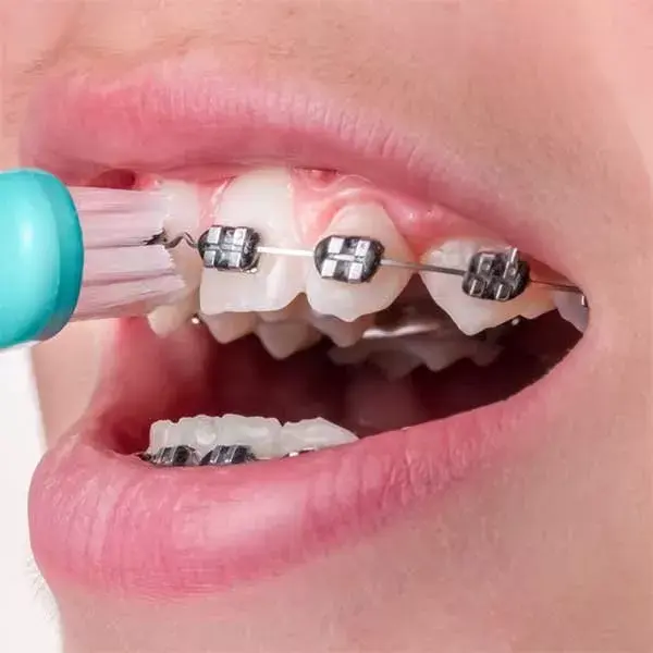 Pierre Fabre Oral Care - Routine d'hygiène bucco dentaire pour les porteurs d'appareils dentaires/ orthodontiques - adultes & adolescents