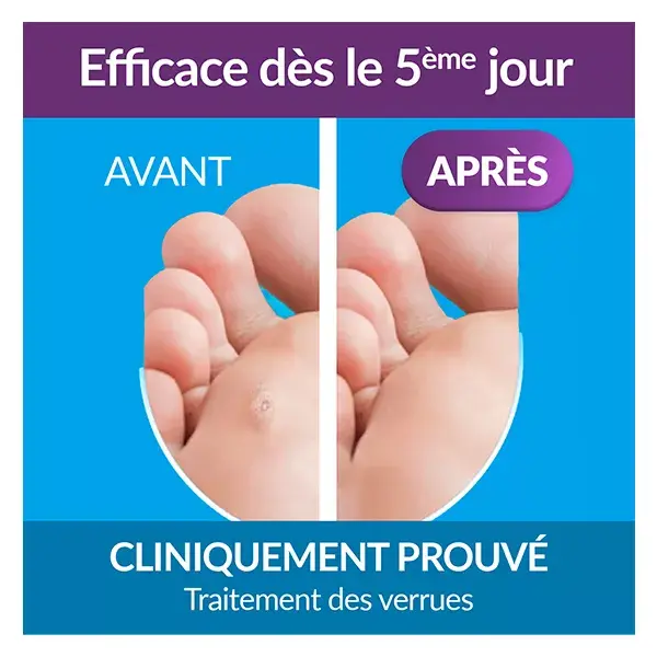 Excilor Verrues Duo Power Cryothérapie & gel acide Mains/pieds Résultats 5j