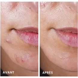 Avène Cleanance Routine Anti-Imperfections