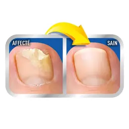 Scholl Solution Mycoses des Ongles Système 2 en 1